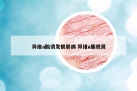 异维a酸诱发银屑病 异维a酸脱屑