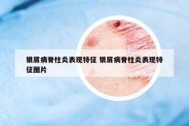 银屑病脊柱炎表现特征 银屑病脊柱炎表现特征图片