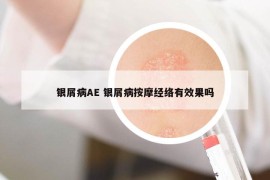 银屑病AE 银屑病按摩经络有效果吗