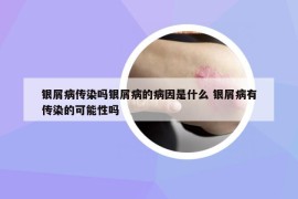 银屑病传染吗银屑病的病因是什么 银屑病有传染的可能性吗