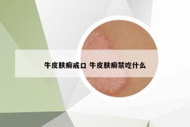 牛皮肤癣戒口 牛皮肤癣禁吃什么