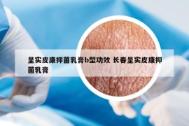 呈实皮康抑菌乳膏b型功效 长春呈实皮康抑菌乳膏