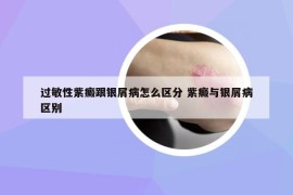 过敏性紫癜跟银屑病怎么区分 紫癜与银屑病区别