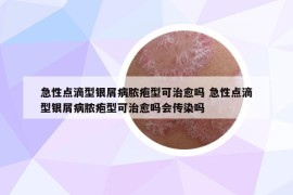 急性点滴型银屑病脓疱型可治愈吗 急性点滴型银屑病脓疱型可治愈吗会传染吗