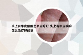 头上有牛皮病癣怎么治疗好 头上有牛皮病癣怎么治疗好的快