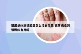 银屑病吃消银胶囊怎么没有效果 银屑病吃消银颗粒有用吗