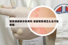 银屑病顽鲜净有用吗 顽固银屑病怎么治才能断根