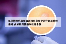 氯倍他索乳膏和卤米松乳膏哪个治疗银屑病效果好 卤米松与倍他米松哪个强