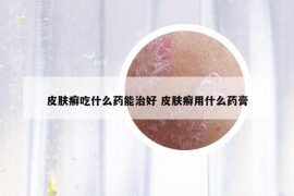 皮肤癣吃什么药能治好 皮肤癣用什么药膏