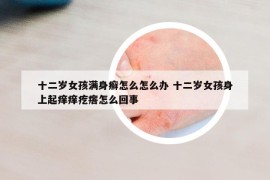 十二岁女孩满身癣怎么怎么办 十二岁女孩身上起痒痒疙瘩怎么回事