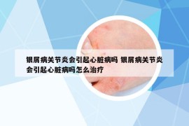 银屑病关节炎会引起心脏病吗 银屑病关节炎会引起心脏病吗怎么治疗