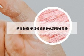 手指长癣 手指长癣用什么药膏好得快