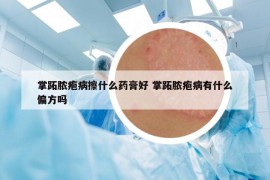 掌跖脓疱病擦什么药膏好 掌跖脓疱病有什么偏方吗