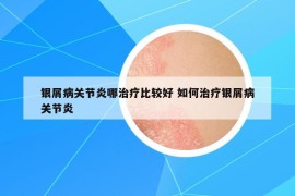 银屑病关节炎哪治疗比较好 如何治疗银屑病关节炎