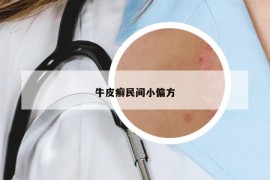 牛皮癣民间小偏方