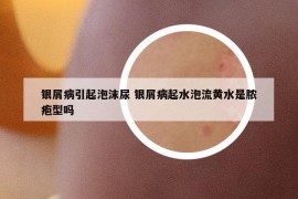 银屑病引起泡沫尿 银屑病起水泡流黄水是脓疱型吗