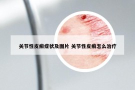 关节性皮癣症状及图片 关节性皮癣怎么治疗