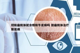 切除扁桃体就会根除牛皮癣吗 割扁桃体治疗银屑病