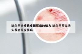 洁尔阴治疗头皮银屑病的偏方 洁尔阴可以洗头发治头皮屑吗