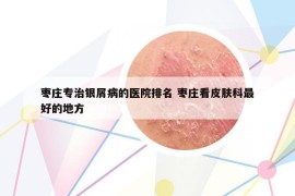 枣庄专治银屑病的医院排名 枣庄看皮肤科最好的地方