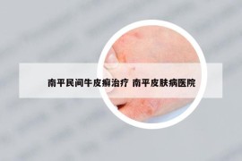 南平民间牛皮癣治疗 南平皮肤病医院