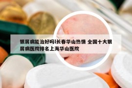 银屑病能治好吗l长春华山热情 全国十大银屑病医院排名上海华山医院