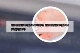 银屑病输血给你会得病嘛 银屑病输血给你会得病嘛知乎