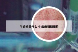 牛癖癣是什么 牛癖癣初期图片