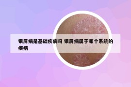 银屑病是基础疾病吗 银屑病属于哪个系统的疾病