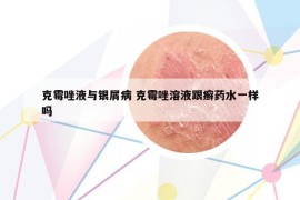 克霉唑液与银屑病 克霉唑溶液跟癣药水一样吗