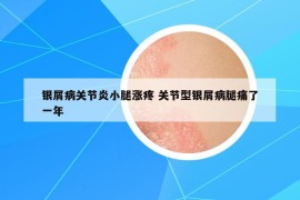 银屑病关节炎小腿涨疼 关节型银屑病腿痛了一年