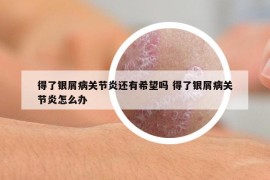 得了银屑病关节炎还有希望吗 得了银屑病关节炎怎么办