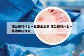 蒲公英和什么一起泡水治癣 蒲公英和什么一起泡水功效好