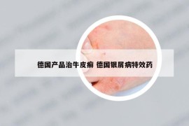 德国产品治牛皮癣 德国银屑病特效药