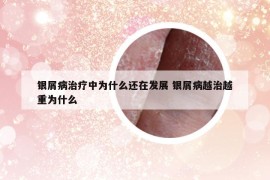 银屑病治疗中为什么还在发展 银屑病越治越重为什么