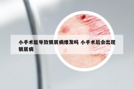 小手术能导致银屑病爆发吗 小手术后会出现银屑病