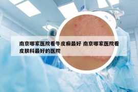 南京哪家医院看牛皮癣最好 南京哪家医院看皮肤科最好的医院