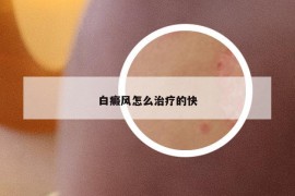 白癜风怎么治疗的快