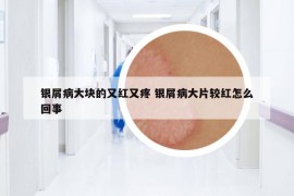 银屑病大块的又红又疼 银屑病大片较红怎么回事