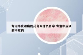 专治牛皮顽癣的药膏叫什么名字 专治牛皮顽癣中草药