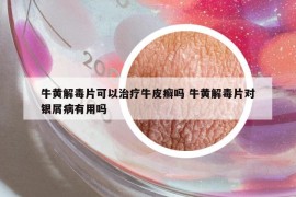 牛黄解毒片可以治疗牛皮癣吗 牛黄解毒片对银屑病有用吗