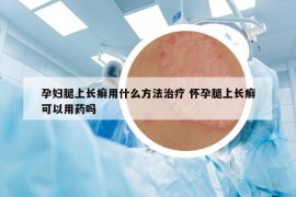 孕妇腿上长癣用什么方法治疗 怀孕腿上长癣可以用药吗