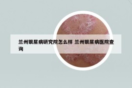 兰州银屑病研究院怎么样 兰州银屑病医院查询