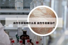 血热牛皮癣喝什么茶 血热牛皮廨治疗