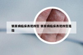 银屑病临床表现四型 银屑病临床表现四型是指