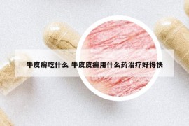 牛皮癣吃什么 牛皮皮癣用什么药治疗好得快