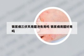 银屑病三伏天用醋泡有用吗 银屑病用醋好用吗