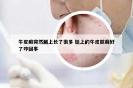 牛皮癣突然腿上长了很多 腿上的牛皮肤癣好了咋回事