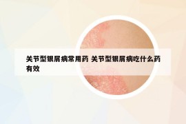 关节型银屑病常用药 关节型银屑病吃什么药有效