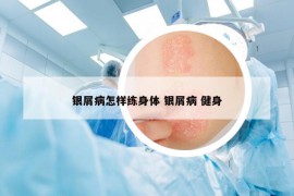 银屑病怎样练身体 银屑病 健身